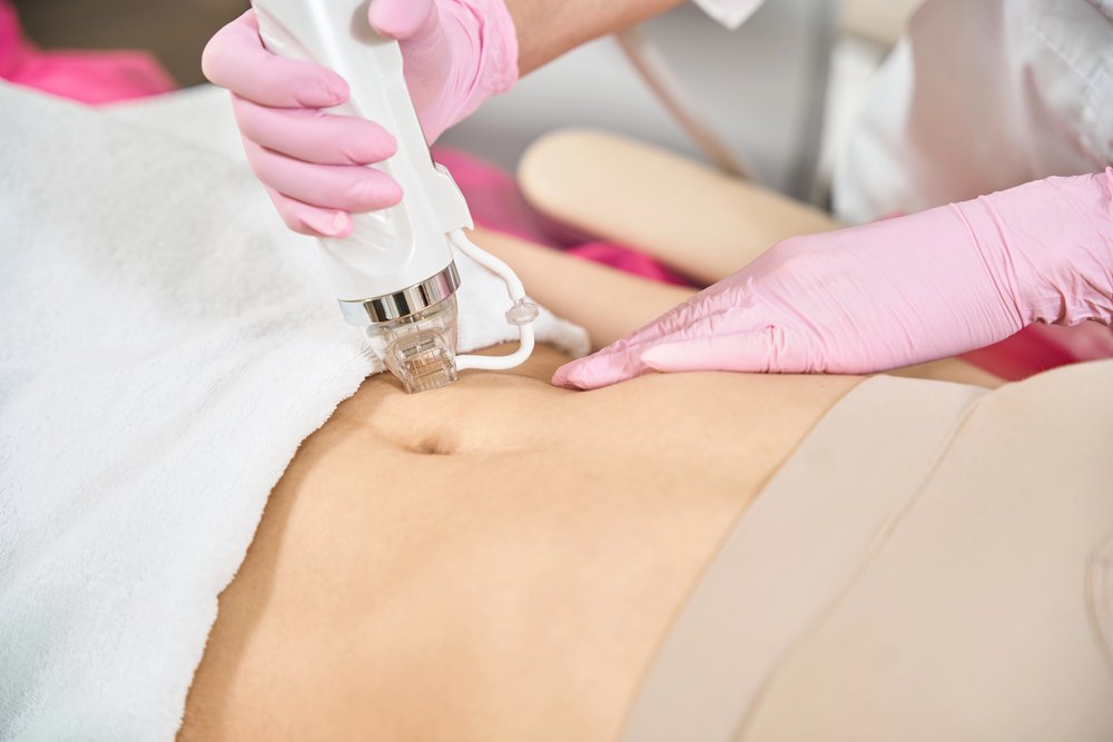 Abdomen RF Microneedling