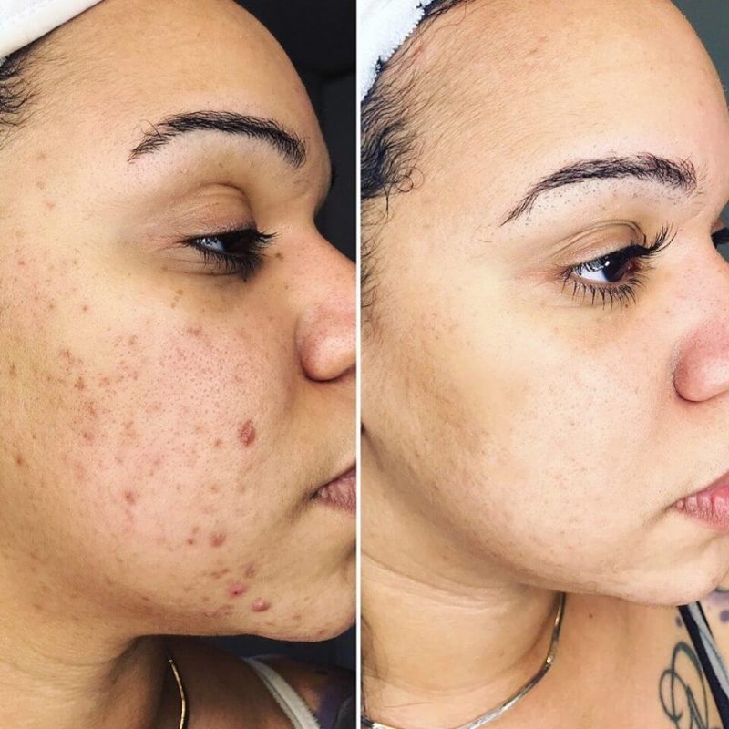 Acne Scarring VI Peel Hover
