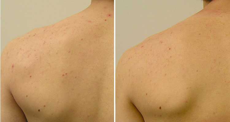 Back Hydrafacial Hover