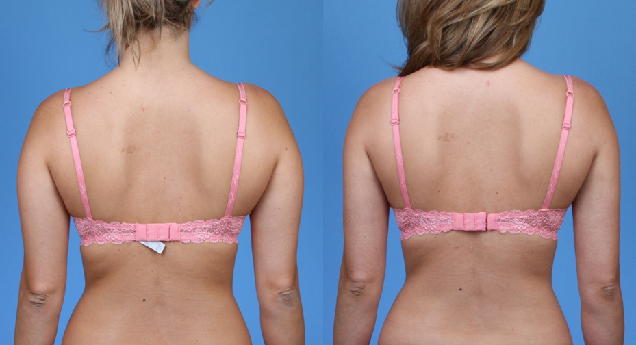 Bra Fat Sculp RF Microneedling Hover