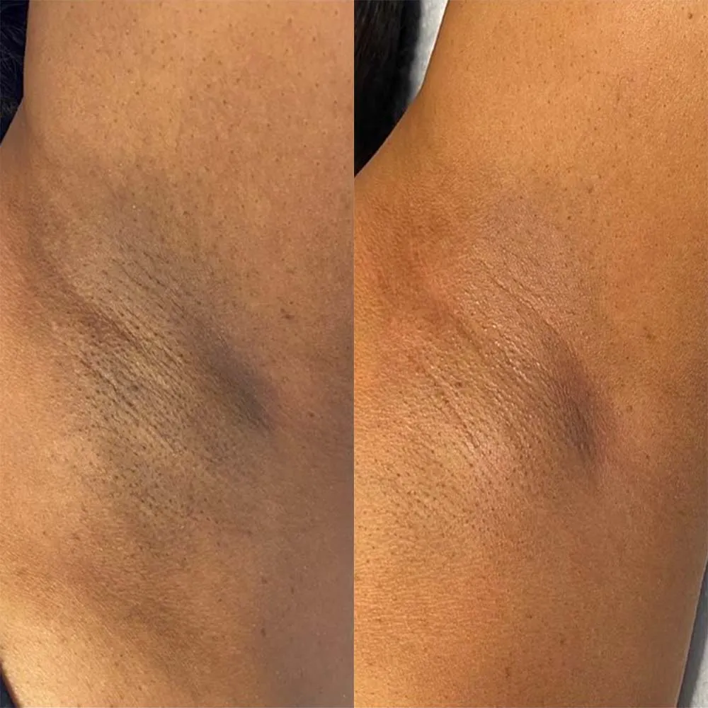 Underarms Chemical Peel Hover