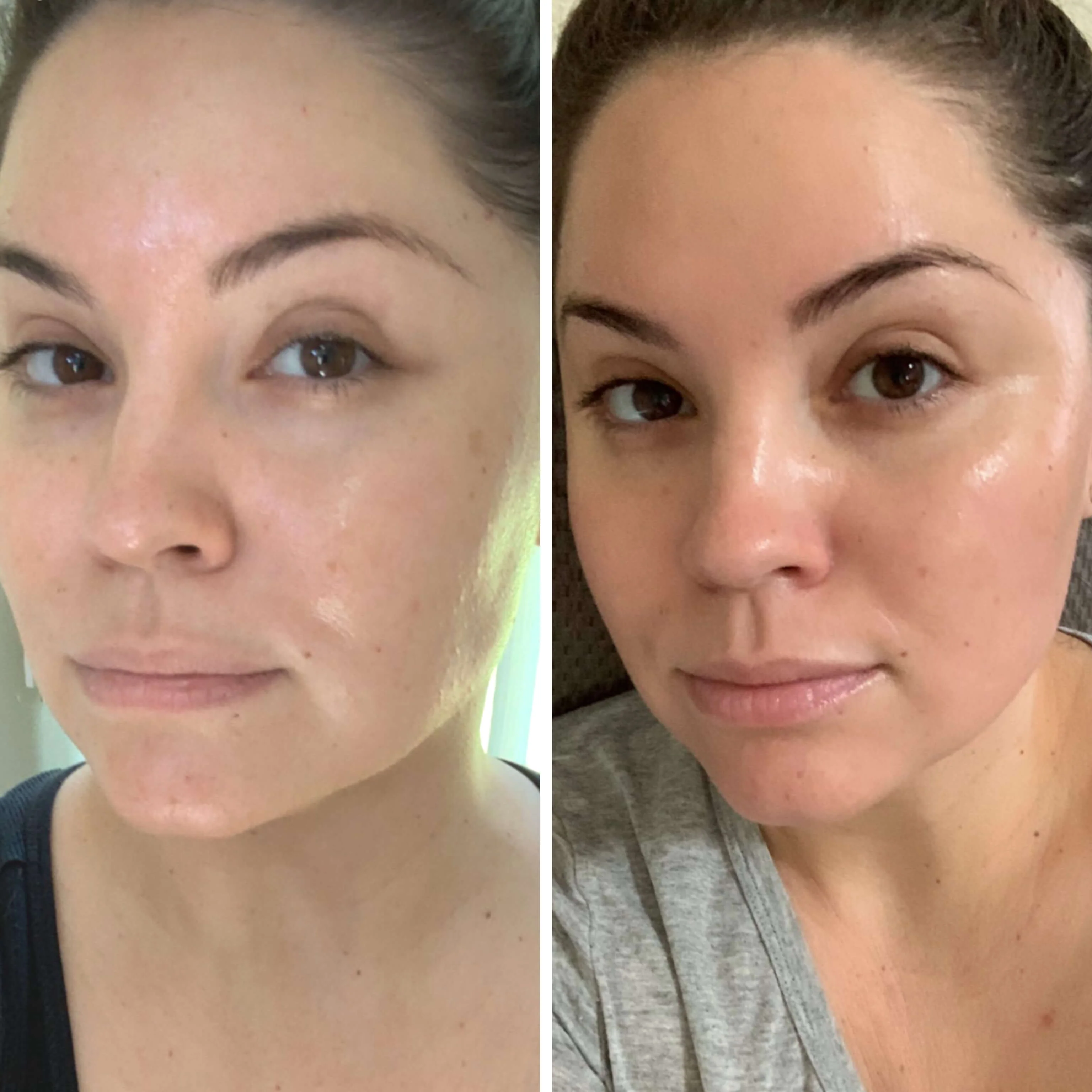 Face & Neck Chemical Peel Hover