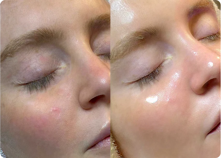 Hydrafacial Hover