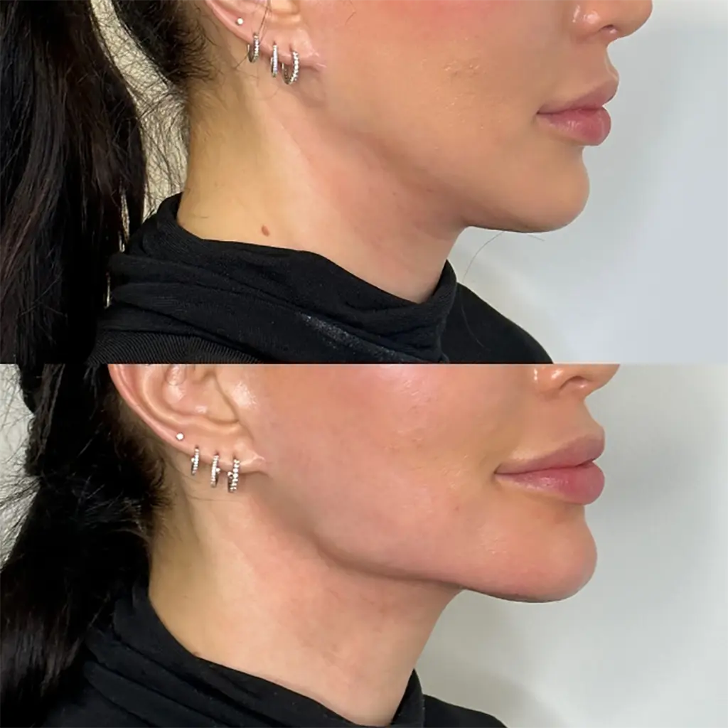 Jawline Filler Hover