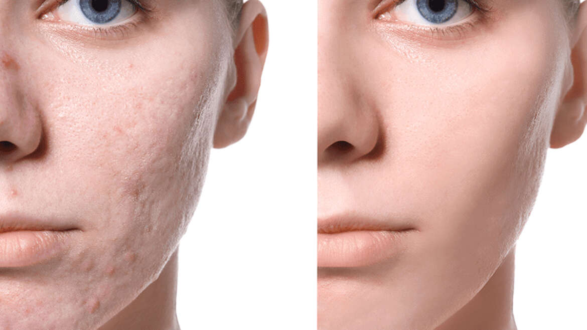 Laser Acne Facial Hover