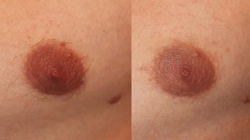 Areolas Laser Hair Removal Hover