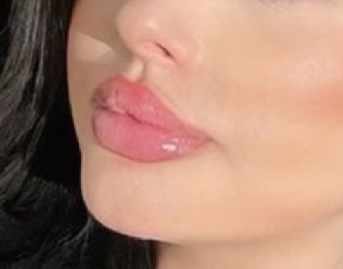 Chin Laser Hair Removal