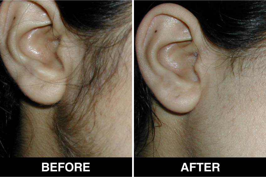 Ears Laser Hair Removal Hover