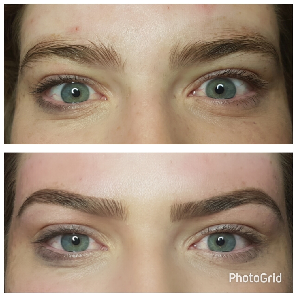 Eyebrows Laser Hair Removal Hover
