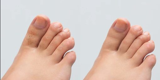 Feet & Toes Laser Hair Removal Hover