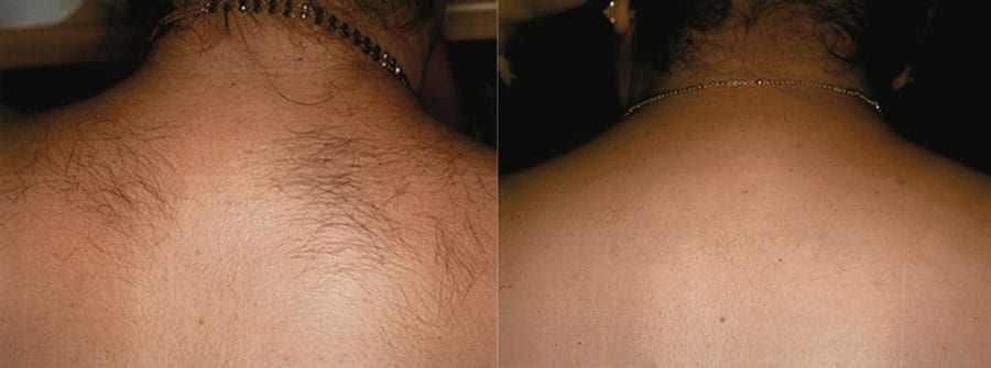 Full Back Laser Hair Removal Hover