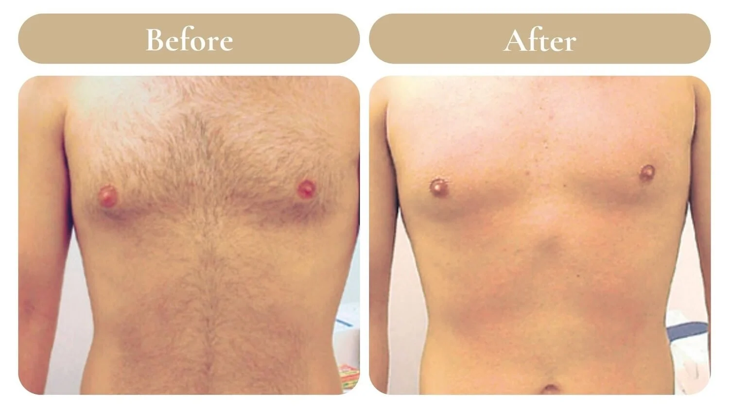 Full Chest Laser Hair Removal Hover