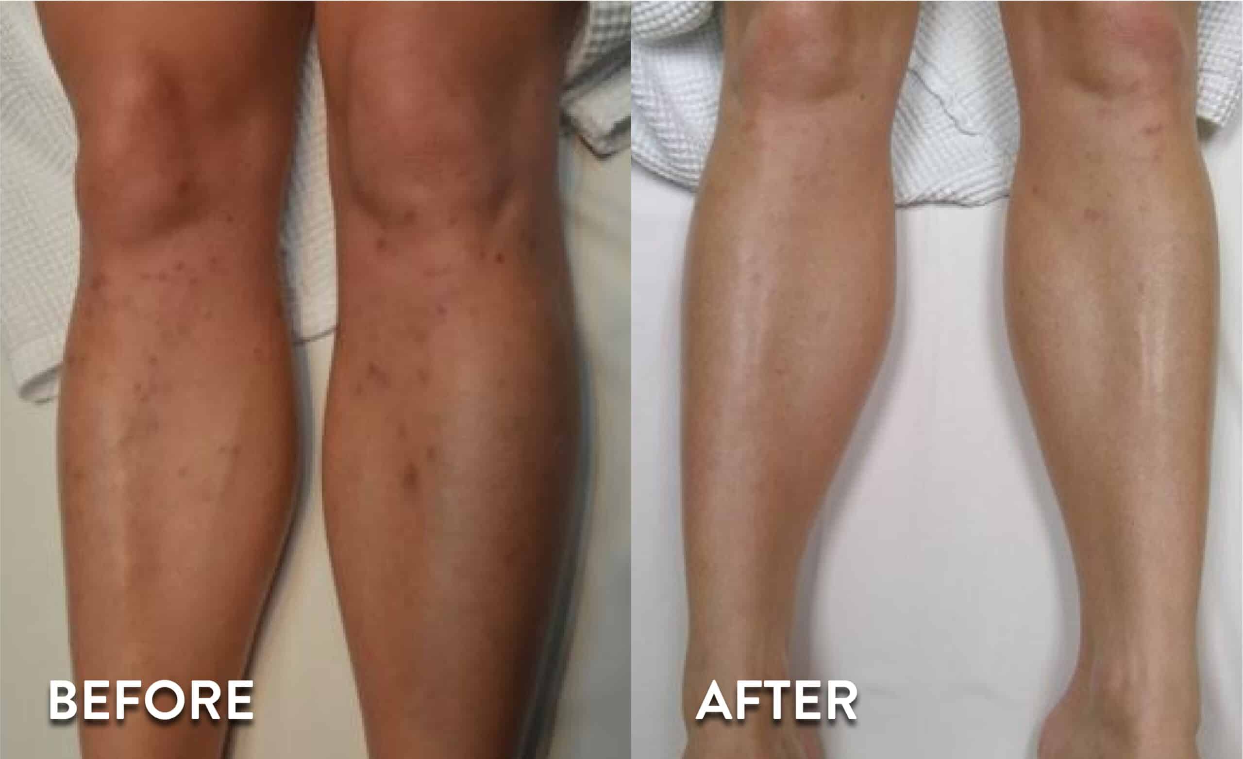 Full Legs Laser Hair Removal Hover