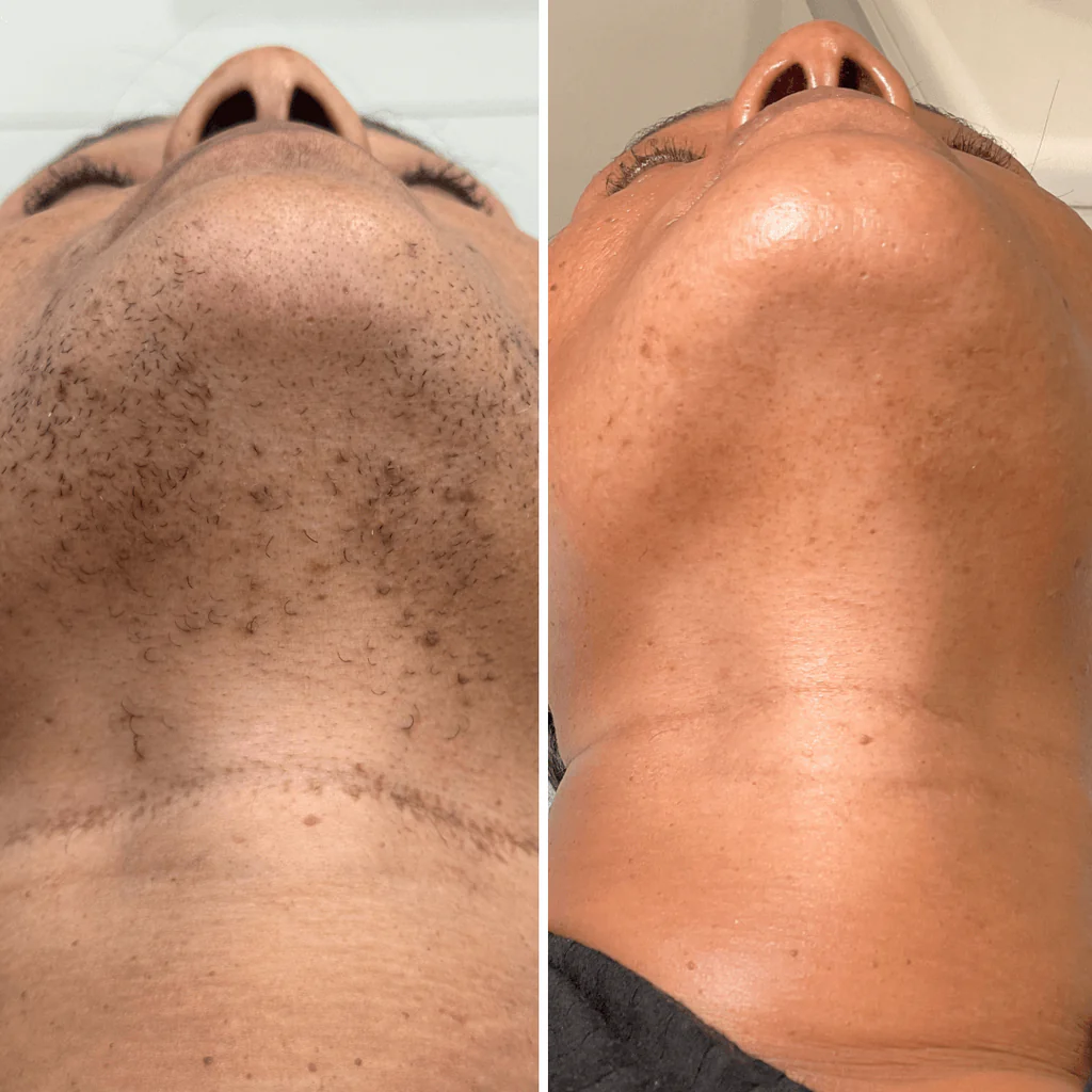 Jawline Laser Hair Removal Hover