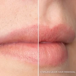 Limited Time $99 Upper Lip Laser Hair Removal Hover