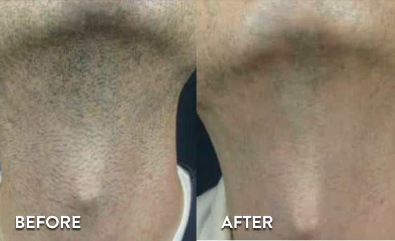Neck Laser Hair Removal Hover