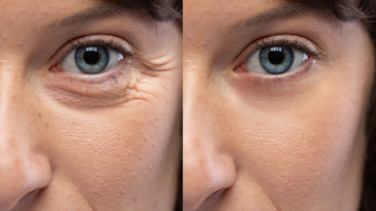 Laser Resurfacing Facial Hover