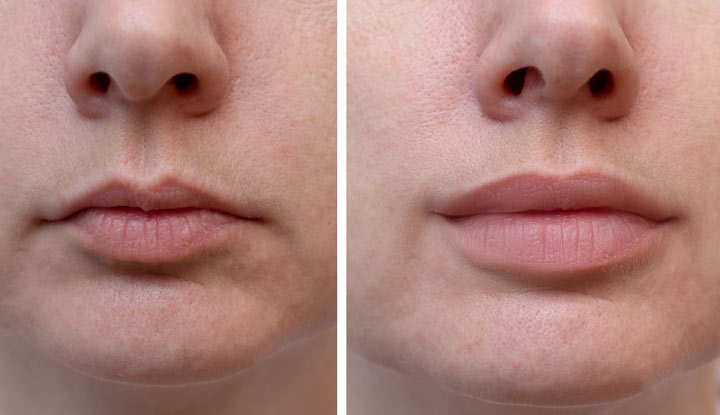 Lip Filler Hover
