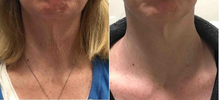 Neck RF Microneedling Hover