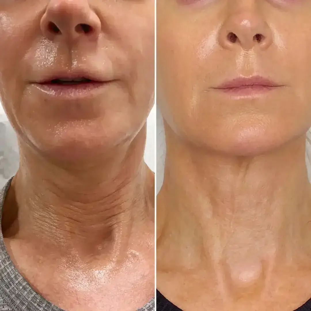 Nose Filler Hover