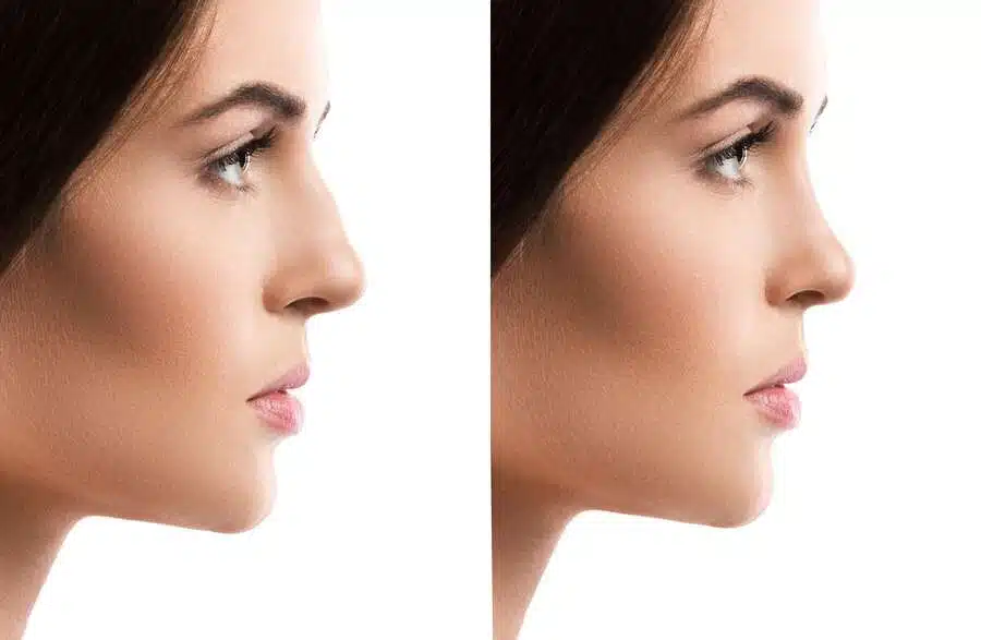 Nose Filler Hover