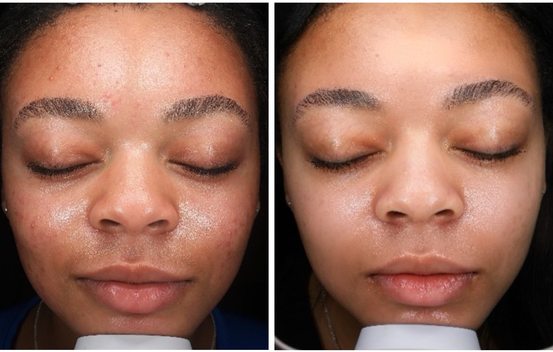 Signature Hydrafacial Hover